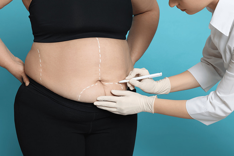 Liposuction
